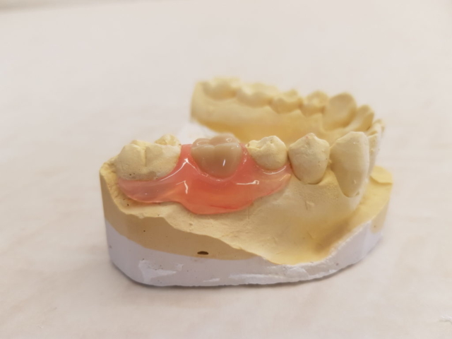Valplast sectional denture